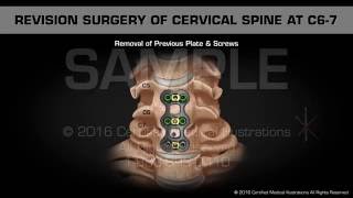 Revision Surgery of Cervical Spine at C67 [upl. by Leland204]