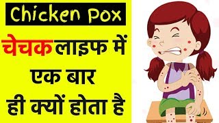 Chechak Life Mein Ek Baar Hi Kyon Hota Hai Why does chickenpox happen once in life [upl. by Nunnery]