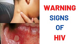 What are the earliest symptoms of HIV [upl. by Weatherley915]