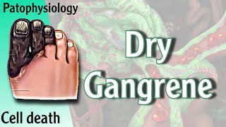 Dry Gangrene Necrosis شرح [upl. by Eirotal]