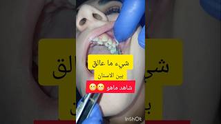 ازالة اداة محشورة بين الاضراس بعيادة طبيب الاسنان سوريا تركيا حمص dentist stitch اكسبلور [upl. by Linnette53]