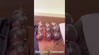 Cupping Therapy For Back Pain [upl. by Windy272]