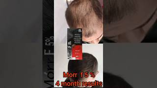 Morr f 5℅ minoxidil hair growth result after 4 months😇hair treatmenthair solution [upl. by Ingram]