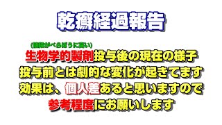 【乾癬】約1年前に、生物学的製剤投与開始して、現在皮膚の様子 [upl. by Osnofla]