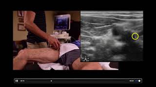 Deep Vein Thrombosis  Diagnosis with Ultrasound [upl. by Nanji]