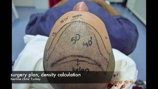 Hair Transplant Turkey REPAIR HAIR TRANSPLANT FUE 3340 GRAFTS [upl. by Atinahs261]