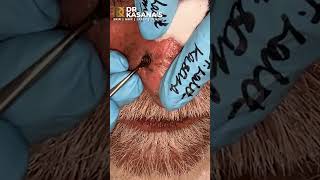 Nose Blackheads  Removal by DrLalit Kasana [upl. by Jc]