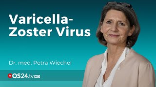 Windpocken amp Gürtelrose Gemeinsamkeiten und Schutzmassnahmen  Dr med Petra Wiechel  QS24 [upl. by Holt]