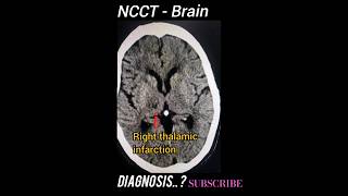 Thalamic Stroke  NCCT Brain  Diagnosis  Practical case [upl. by Nagar]