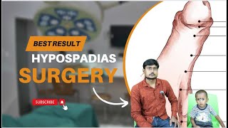 Hypospadias  मूत्र का छिद्र सही जगह पर न खुलने की समस्या  Hypospadias Repair in India  Dr Nagwani [upl. by Noman]