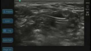 Ultrasound Guided Interscalene Catheter [upl. by Leunam]