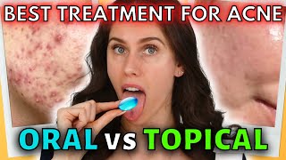 Oral vs Topical Acne Medications  Which Is Best For You [upl. by Cchaddie]