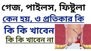 গ্যাজ রোগের চিকিৎসা । piles treatmenthemorrhoids treatmentpiles treatment at homepiles problem [upl. by Geibel]