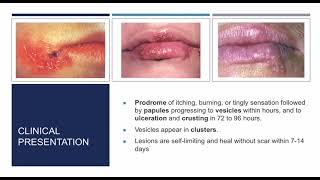 Gingival diseases in children part 2 [upl. by Anirt]