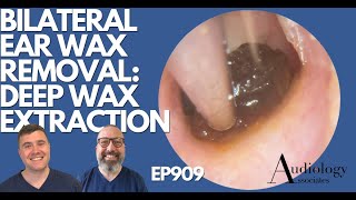 BILATERAL EAR WAX REMOVAL DEEP WAX EXTRACTION  EP909 [upl. by Ebner519]