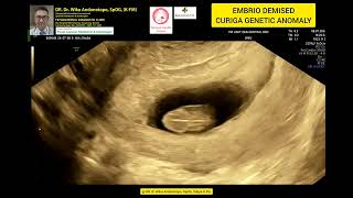 Embryo demised 10 weeks [upl. by Acinot]