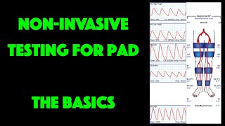 NonInvasive Testing for Peripheral Artery Disease [upl. by Akfir]