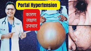 portal hypertension sign and Symptoms and management [upl. by Emily]