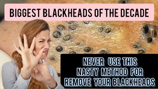 Nasty and lengthy blackhead removal bent needle historical method DrAMAZINGSKIN [upl. by Yeslehc]