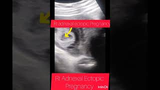 Ultrasound showing Ectopic PregnancyRt Adnexal Ectopic Pregnancyviralshortyoutubeshortsbabyuk [upl. by Hgielar626]