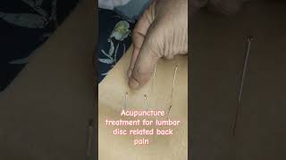 Acupuncture to avoid back surgery acupuncturists alternativemedicine acupuncturelife painrelief [upl. by Enyledam]