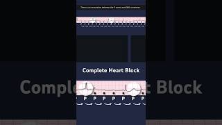 Third Degree Atrioventricular Block ECG P waves [upl. by Sheree597]