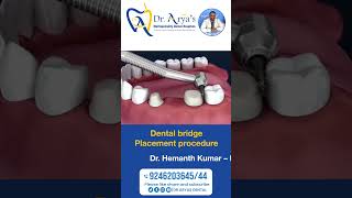 dental bridge placement procedure [upl. by Ttegdirb]