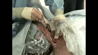 Placement of Central Venous Catheter  NEJM [upl. by Salim]