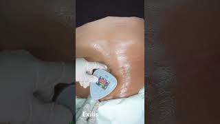 Exilis treatment bodytreatment karmalite fatloss [upl. by Kristel]