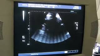 MULTICYSTIC DYSPLASTIC KIDNEYS of FETUS [upl. by Nivrad736]