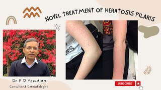 A novel treatment for Keratosis pilaris [upl. by Nauwtna]