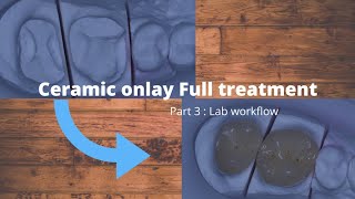 Ceramic onlay full treatment  Part 3  Lab workflow [upl. by Bucky]