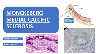 Monckeberg Medial Calcific Sclerosis  Doodle Animation  Images  Made Easy [upl. by Nailuj]