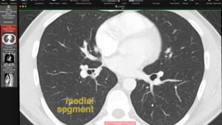 Lobar and Segmental Lung Anatomy on CT [upl. by Chrisse812]