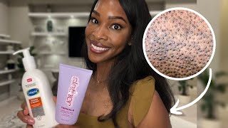 How to Get Rid of Textured Bumpy Rough Skin  Keratosis Pilaris [upl. by Nniw128]