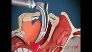 Endotracheal Intubation Animation [upl. by Aip]