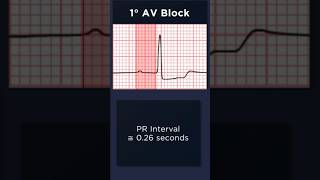 First Degree Atrioventricular Block ECG Example 1 [upl. by Enilamme]