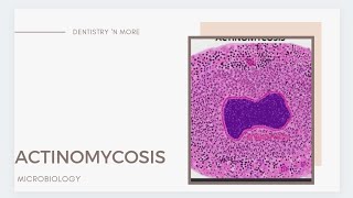 ACTINOMYCOSIS [upl. by Doss]