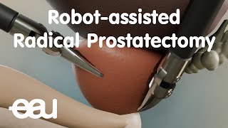 Robotassisted Radical Prostatectomy RARP [upl. by Agueda915]