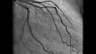 Coronary Angiography  NEJM [upl. by Nixie]