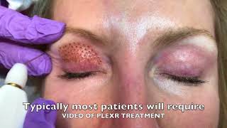 PLEXR PLASMA Eyelid Blepharoplasty [upl. by Akerdal]