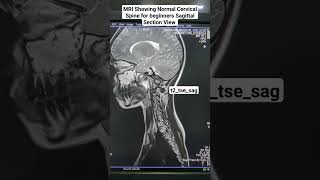 MRI t2tsesag Sequence Showing Normal Cervical Spine for Beginners anatomy [upl. by Remled]