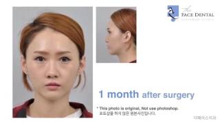 더페이스치과 양악수술Double jaw surgery Before amp After [upl. by Naus]