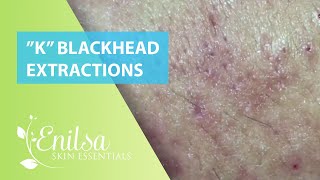 Blackheads Extractions “K’s” 2nd Treatment [upl. by Jallier383]