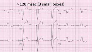 Left Bundle Branch Block [upl. by Nollaf179]