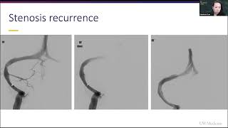 IIH Stenosis Recurrence amp Complications of Venous Sinus Stenting w Neurosurgeon Stephanie Chen MD [upl. by Aliak]