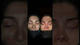 Revision Rhinoplasty Before After [upl. by Nuzzi]