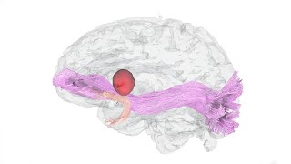 3Dimensional Reconstruction of Dominant Hemisphere Gliomas [upl. by Rodolph116]