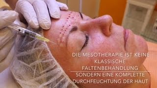 Mesotherapie mit Hyaluronsäure  Behandlung Vorher Nachher [upl. by Honan11]