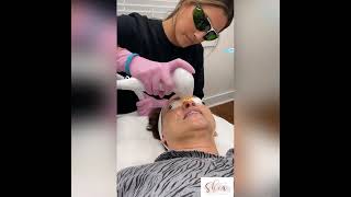 Photofacial to correct summer sun damage and clear up your complexion [upl. by Suivatal]